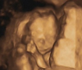 4D Sonogram, Ciordia-Dietz Baby Boy